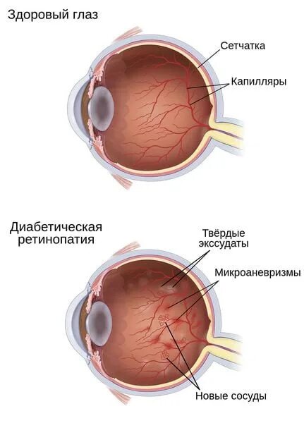 Диабетическая ретинопатия сетчатки глаза. Перициты диабетическая ретинопатия. Диабетическая ретинопатия глаз. Ретинопатия патогенез.