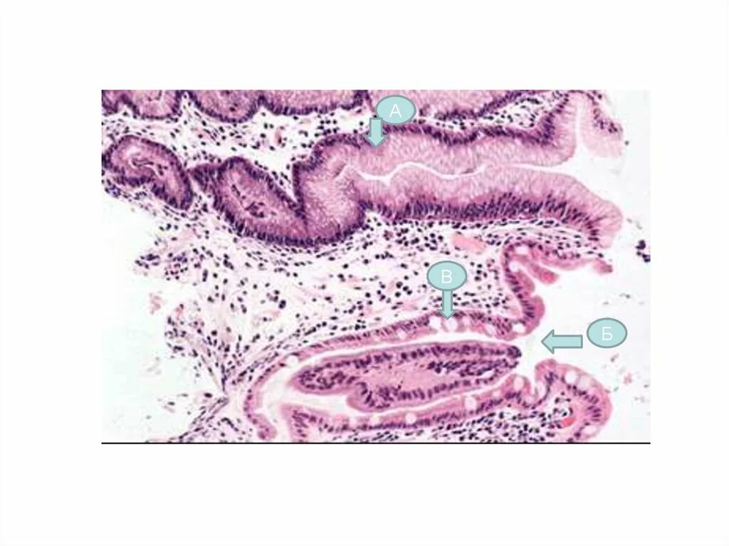 Хронический атрофический гастрит гистология. Хронический атрофический гастрит микропрепарат по Самсонову. Хронический поверхностный гастрит патанатомия. Атрофический гастрит патанатомия. Признаки атрофией слизистой оболочки