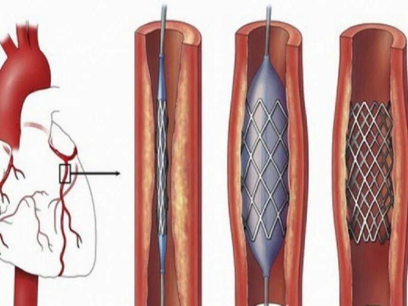 стентирование стентом отклоняющим поток крови. стентирование сосудов сердца после шунтирования. баллонная ангиопластика сосудов сердца. стентирование коронарных сосудов. стентирование пищевода рентген.