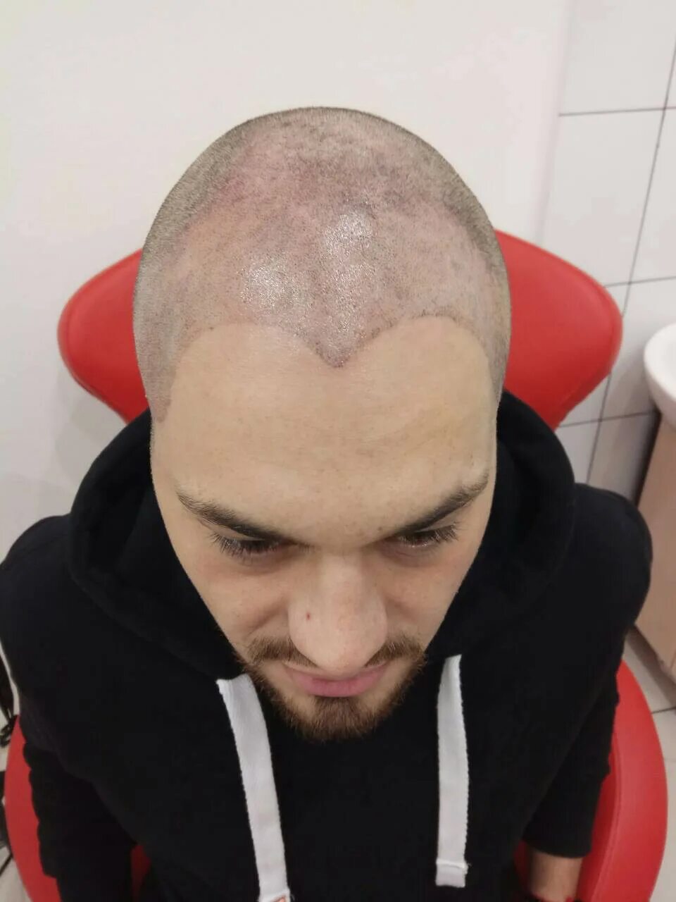 Татуаж головы имитация волос. Лысина трихопигментация. Трихопигментация волос. Трихопигментация головы. Андрей афанасьев трихопигментация.