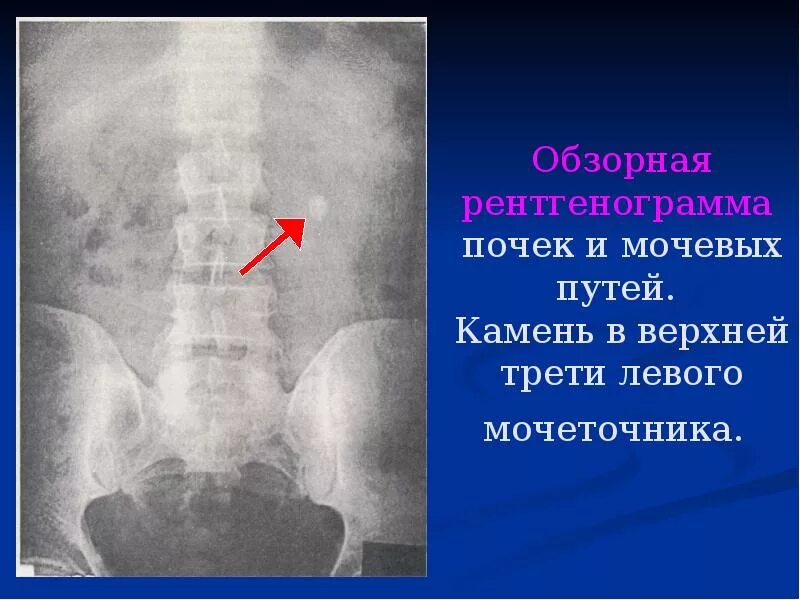 Камни в нижнем мочеточнике. Обзорная урография мочекаменная болезнь. Мкб камень н/3 левого мочеточника. Обзорная урограмма мочекаменная болезнь. Обзорная рентгенограмма почек и мочевых путей.