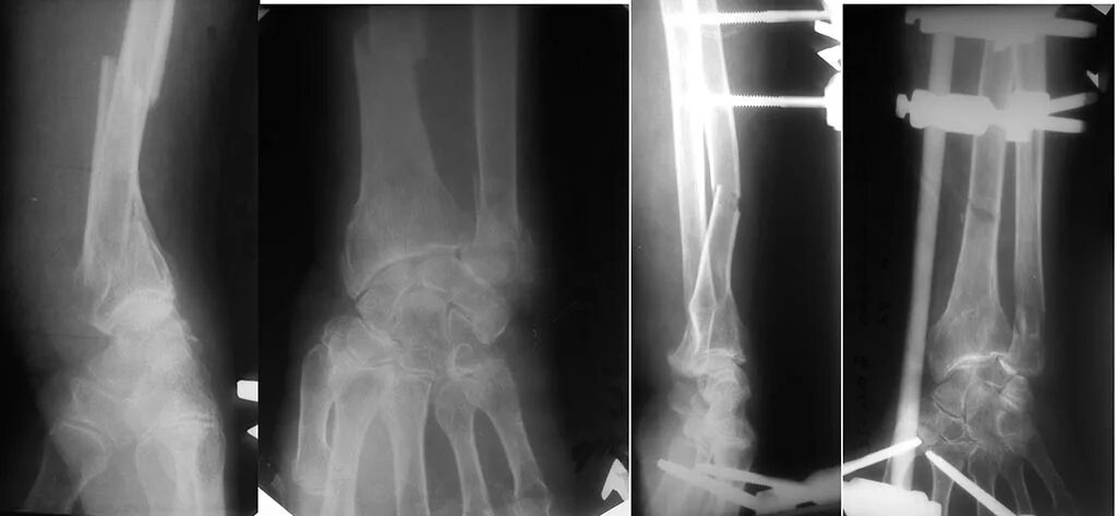 Перелом предплечья симптомы. Перелом предплечья симптомы. Диафизарный перелом костей предплечья. Переломовывих монтеджи сгибательный. Открытый перелом предплечья.