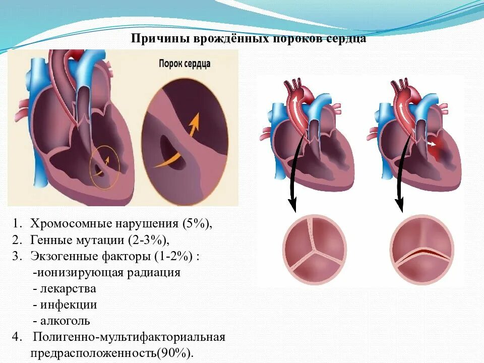 Врожденные аномалии приобретенные аномалии. Причины развития ВПС У детей. Причины врожденного порока сердца. Причины развития у детей врожденного порока сердца. Причины формирования ВПС.