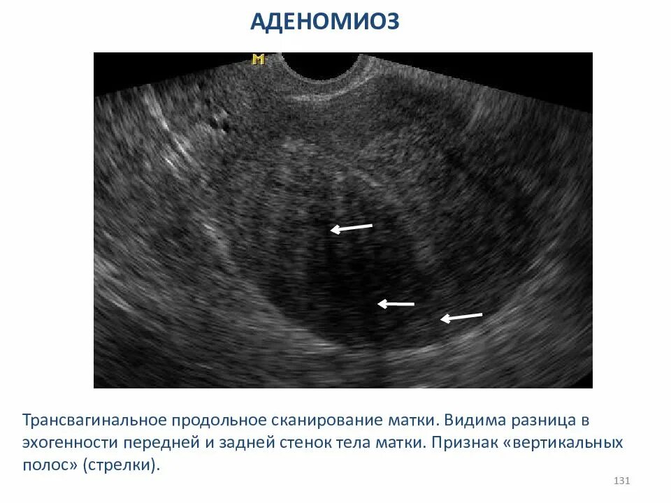 Узлы эндометрия. Внутренний эндометриоз матки на УЗИ. Внутренний эндометриоз на УЗИ. Эндометриоз аденомиоз матки.