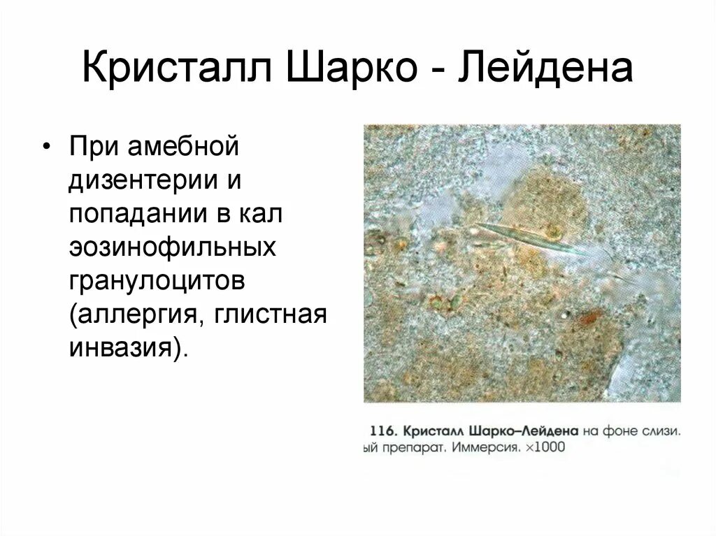 Шарко лейдена в кале. Кристаллы Шарко-Лейдена в Кале. Кристаллы шарколедина. Кристаллы Шарко-Лейдена в Кале у ребенка. Кристаллы Шарко Лейдена в Кале микроскопия.