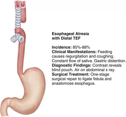 Атрезия пищевода эзофагоскопия. Атрезия пищевода у плода. Атрезия пищевода у новорожденных операция.