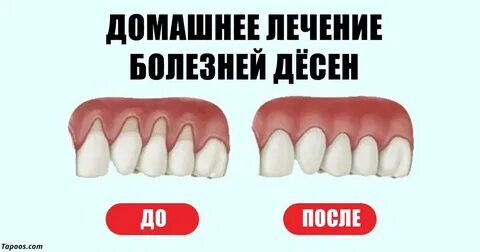 Народный лечение десен