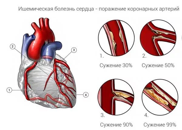 Области ишемии. Ишемичкскаяболезнь сердца. Ишемическая болезнь сердца причины. Ишемическая болезнь сердца (ИБС).