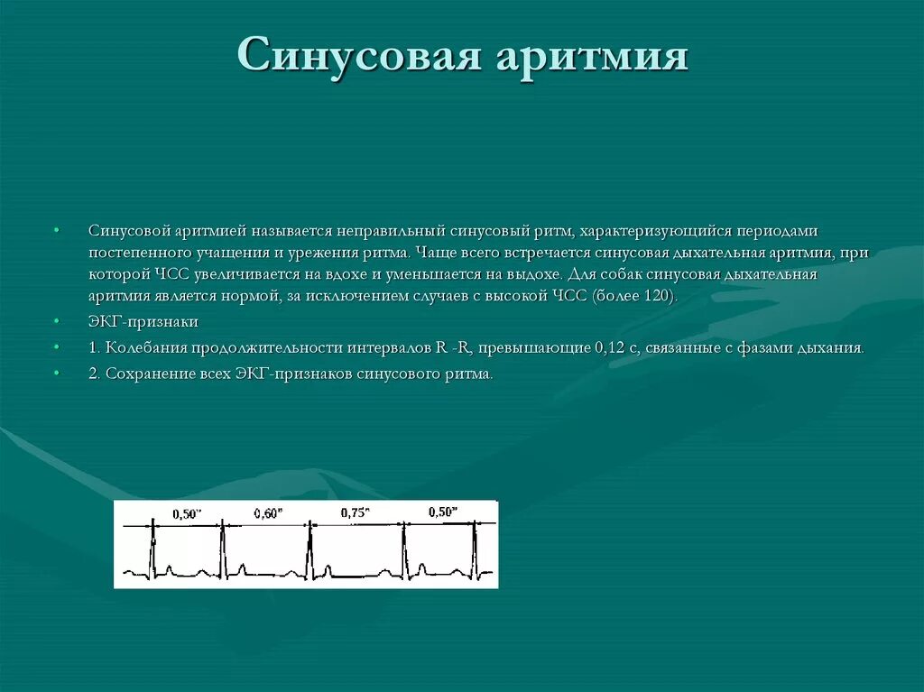 Ритм синусовый что у ребенка. Неправильный синусовый ритм. синусовая аритмия. синусовая дыхательная аритмия. синусовая аритмия с чсс.