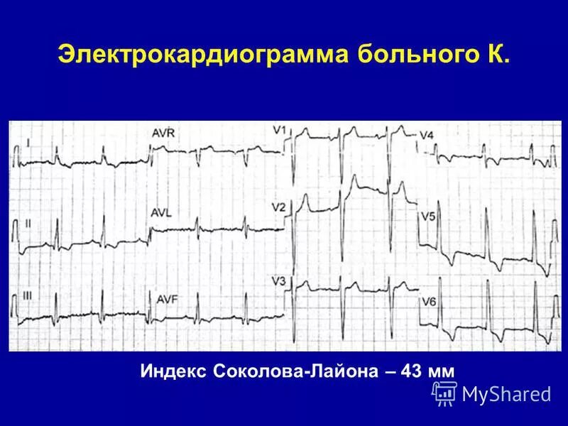 Индексы гипертрофии левого желудочка. Индексы гипертрофии левого желудочка