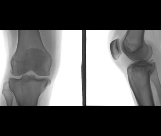 Лигаментоз крестообразных связок коленных. Лигаментоз коленного сустава рентген. Импиджмент синдром коленного сустава. Лигаментоз надколенника рентген. Внутрисуставной лигаментоз коленного сустава рентген.