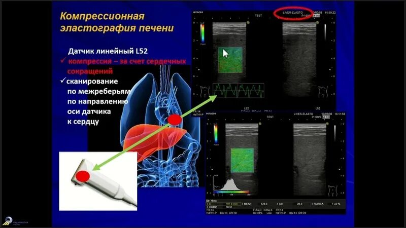 Эластометрия подготовка к процедуре. Компрессионная эластография печени. эластометрия печени сдвиговой волны. ультразвуковая эластография селезенки. заключение фиброскан эластометрия печени.