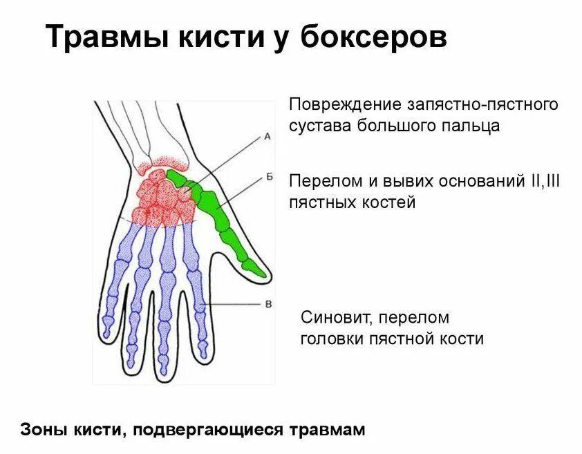 Болит сустав у основания большого пальца руки. Пястно фаланговый сустав кисти. Ушиб запястно пястного сустава. Пястно фаланговый сустав 1 пальца.