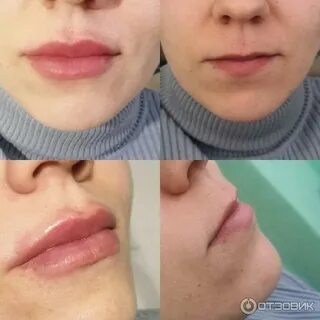 Филлер в губы сколько мл