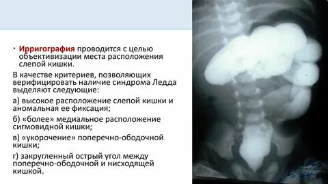 Синдром ледда