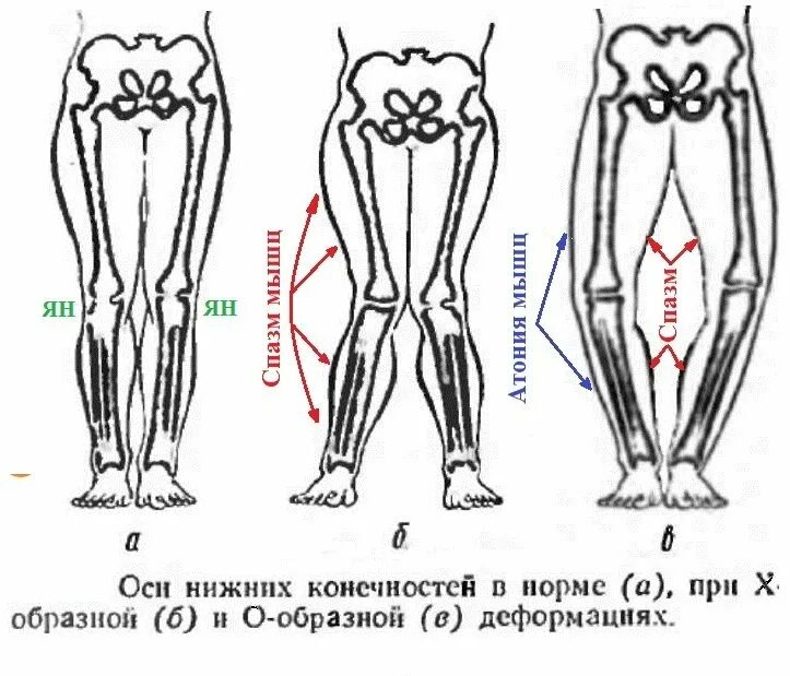 Развитие нижней конечности. Х образная форма ног у детей. X образное искривление ног. Х образное строение ног.