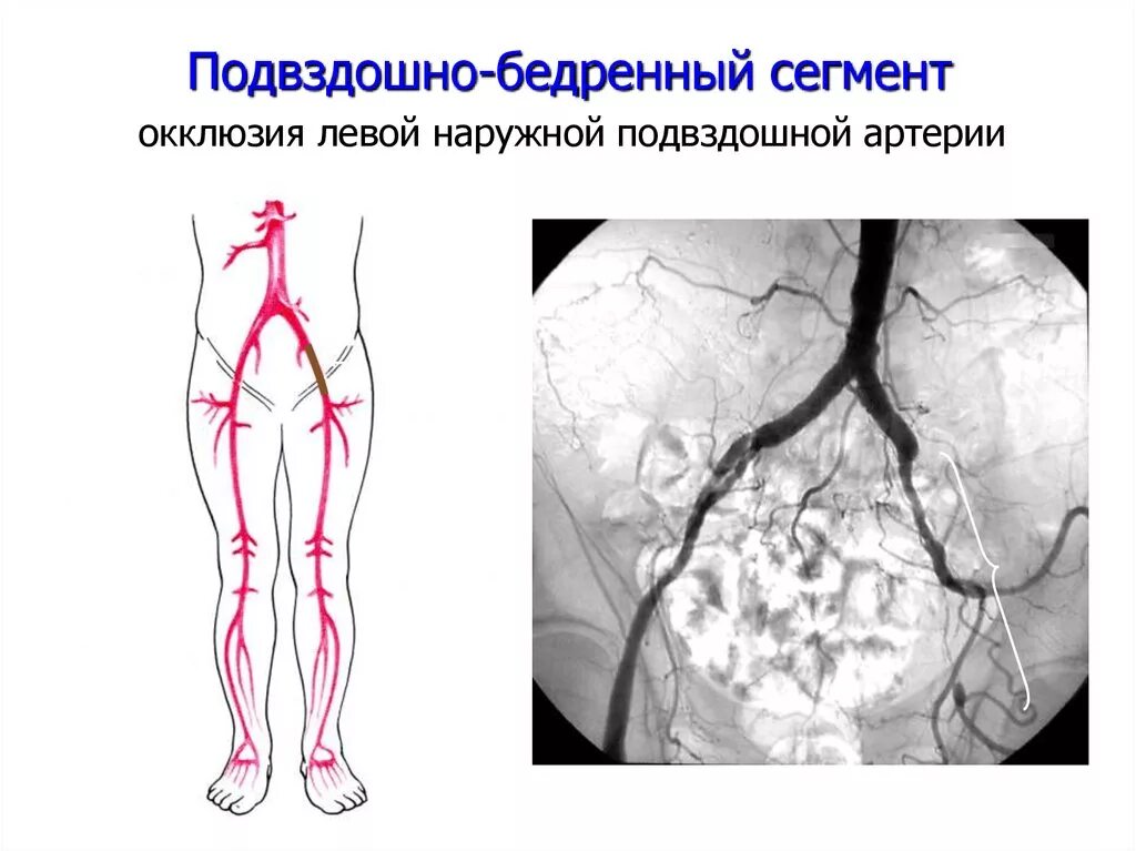 Бифуркационное аорто-бедренное шунтирование. Атеросклероз подвздошных артерий рентген. Операция подвздошно бедренное шунтирование. Ангиография артерий нижних конечностей.