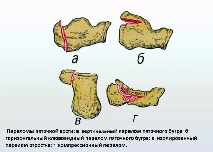 Классификация переломов пяточной кости Essex-Lopresti. Переломы таранной кости классификация. Анатомическая классификация переломов пяточной кости. Перелом пяточной кости (компрессионный перелом).