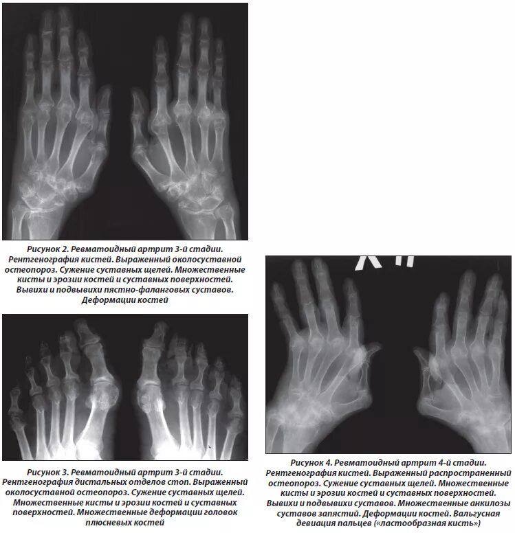 Ревматоидный артрит кисти рентген стадии. Псориатический артрит кистей рентген. Для 3 стадии рентгенологической стадии ревматоидного артрита. Ревматоидный артрит рентген стадии. Ревматоидный артрит суставов кистей