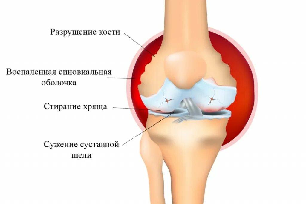 Ювенильный ревматоидный артрит суставная форма. Системный ювенильный ревматоидный артрит. Ювенильный ревматоидный артрит коленного сустава. Ревматоидный артрит коленного сустава у ребенка. Суставы после орви