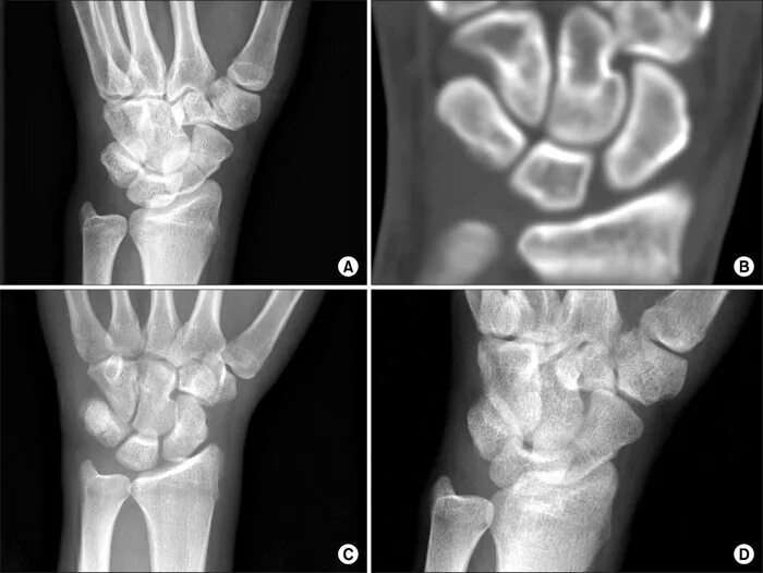 Ладьевидная кость кисти перелом. Ладьевидная кость руки перелом. Ладьевидная кость запястье перелом. Перелом гороховидной кости запястья рентген.
