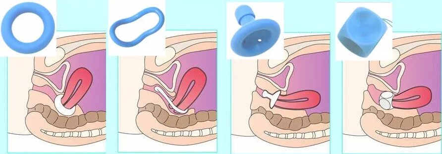 Маточная пессарий акушерский. Установка пессария при беременности. Пессарий гинекологический при беременности. Пессарий гинекологический при опущении. Как ставят пессарий при беременности