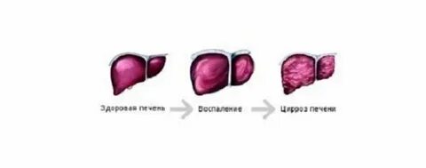 Последняя стадия цирроза печени