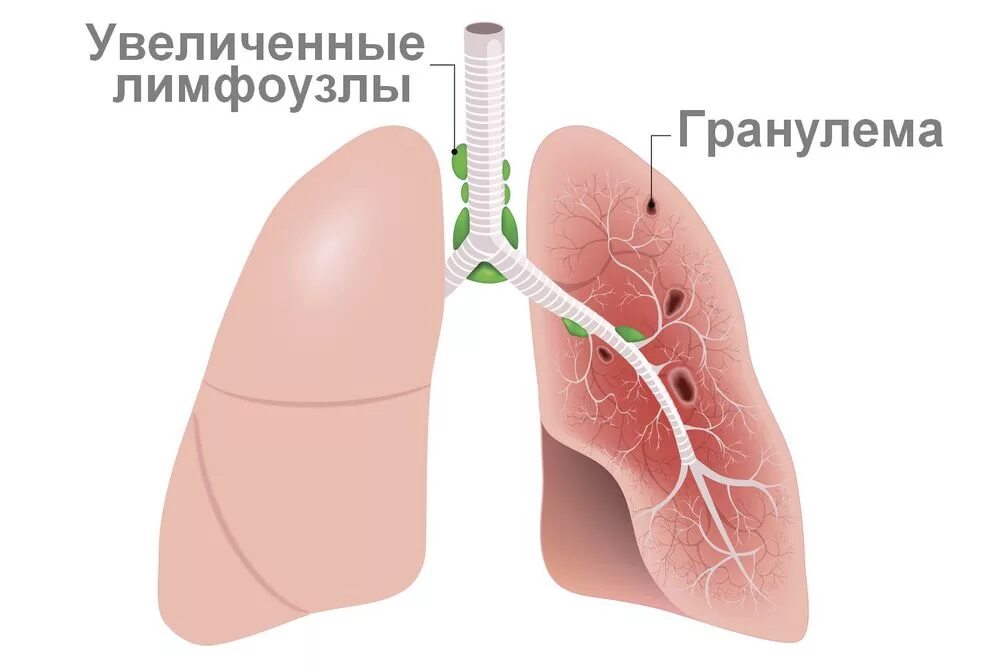 Легкие увеличен узел. Саркоидоз (болезнь Бенье – Бека – Шаумана). Лимфаденопатия при саркоидозе легких.