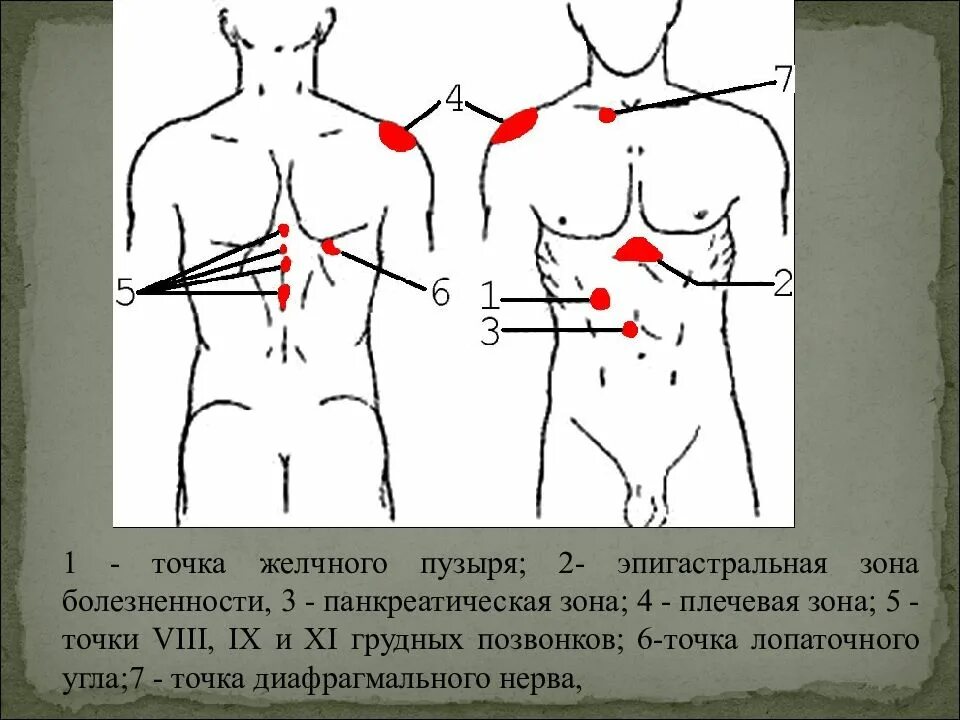 Проекция желчного пузыря на переднюю брюшную стенку. Болезненные точки при желчнокаменной болезни. болевые точки при патологии желчного пузыря. болевые точки при заболеваниях желчных путей. болевые точки при холецистите.