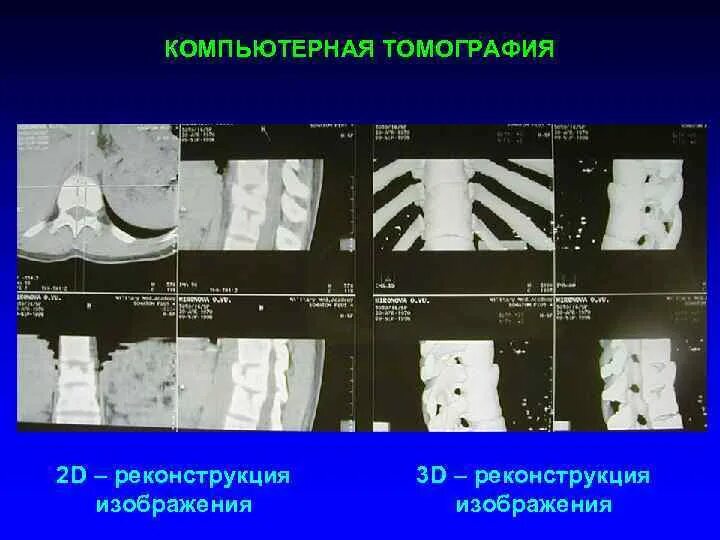 Реконструкция изображений в компьютерной томографии. 3d реконструкция позвоночника мрт. Фронтальная реконструкция кт. Кт реконструкция