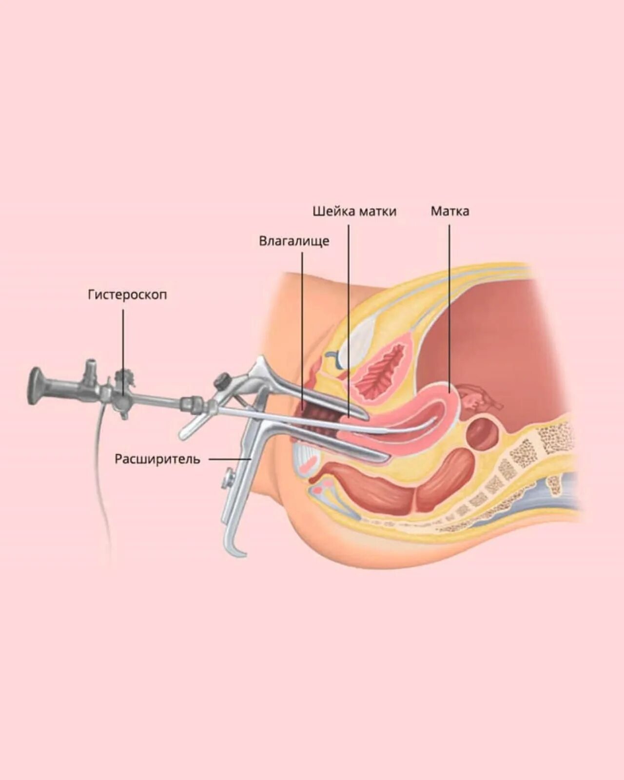 Гистерорезектоскопия удаление матки. Гистерорезектоскопия эндометрия. Операция гистерорезектоскопия. Гистерорезектоскопия полипа. Оперативная гистерорезектоскопия.