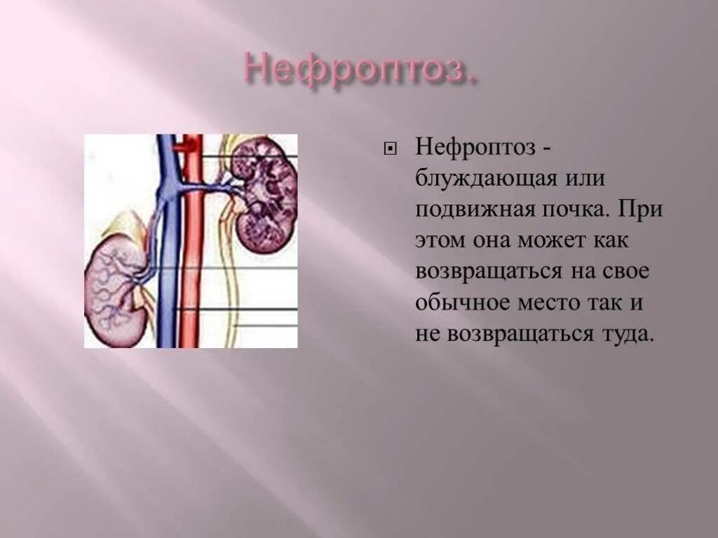 Подвижность правой почки. Нефроптоз почки справа. блуждающая почка у ребенка.