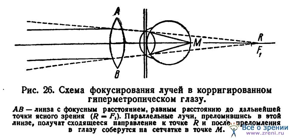 Фокусировка лучей света на внутренней поверхности. Дальнозоркость схема хода лучей. Схема хода параллельного пучка лучей дальнозоркого глаза. Схема преломления лучей в глазу. Ход лучей в глазу схема.