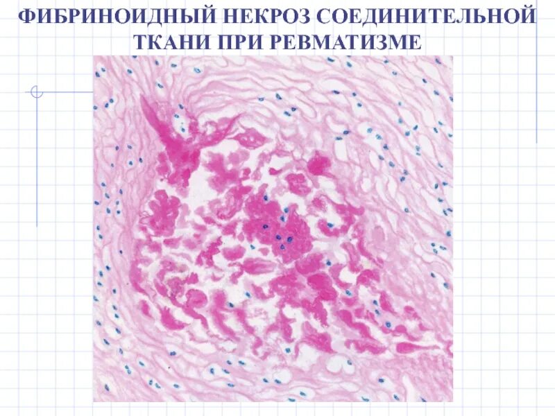Фибриноидный некроз стенки сосуда. Мукоидное набухание фибриноидный некроз. Фибриноидное набухание патанатомия. Фибриноидное набухание гистология. Мукоидное набухание соединительной ткани препарат.