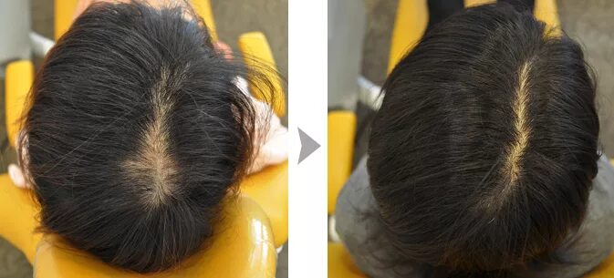 Андрогенная алопеция у женщин. Волосы до после облысение. Болят корни волос на макушке