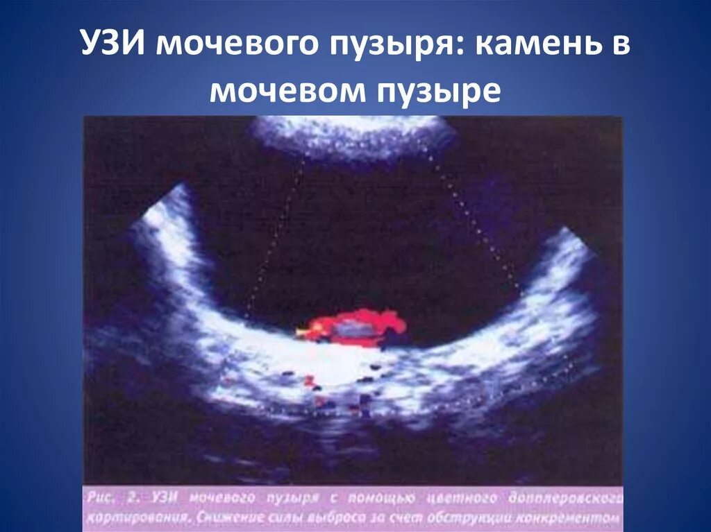 Почему узи мочевого делают на полный. Камни в мочевом пузыре узи. конкременты мочевого пузыря на узи. узи мочевого пузыря на узи.