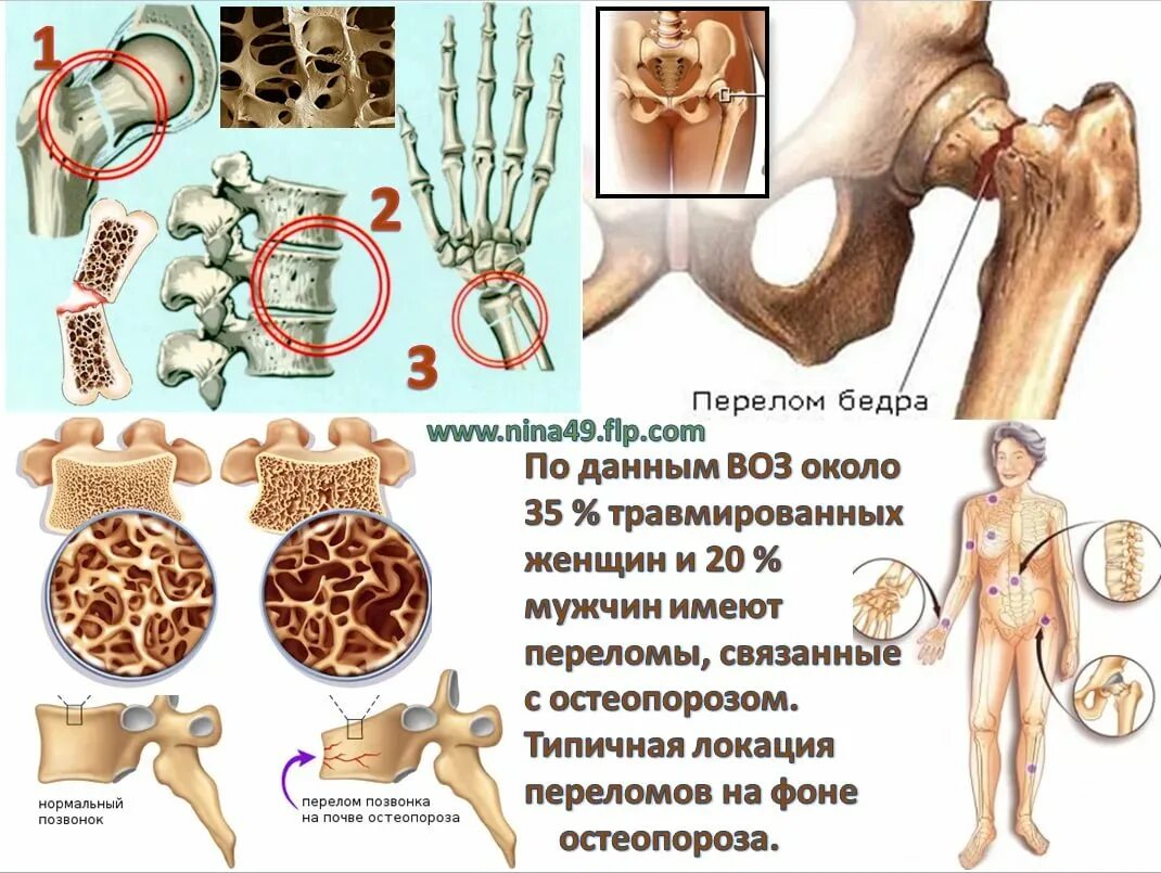 В костях и т д. Остеопороз. Переломы при остеопорозе. Заболевание костей остеопороз. Остеопороз переломы костей.