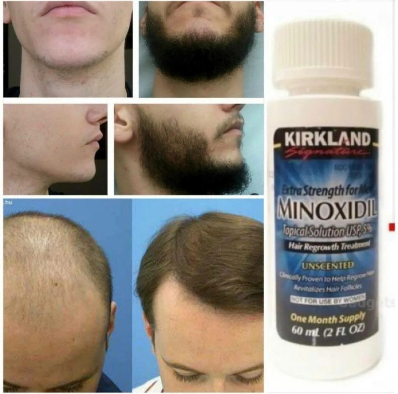 Для роста волос для мужчин отзывы. Миноксидил 5 для волос. Миноксидил 3%. Миноксидил 30%. Миноксидил 100 мл.