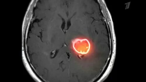 Глиобластома головного мозга. Неоперабельная глиобластома головного мозга.. Больные глиобластомой. Осложнения глиобластомы.
