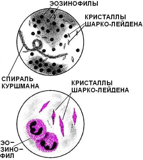 Микроскопическое исследование мокроты спирали Куршмана. Эозинофилы в мокроте микроскопия. Эластические волокна в мокроте микроскопия. Эпителий в мокроте микроскопия. Эозинофилы при астме