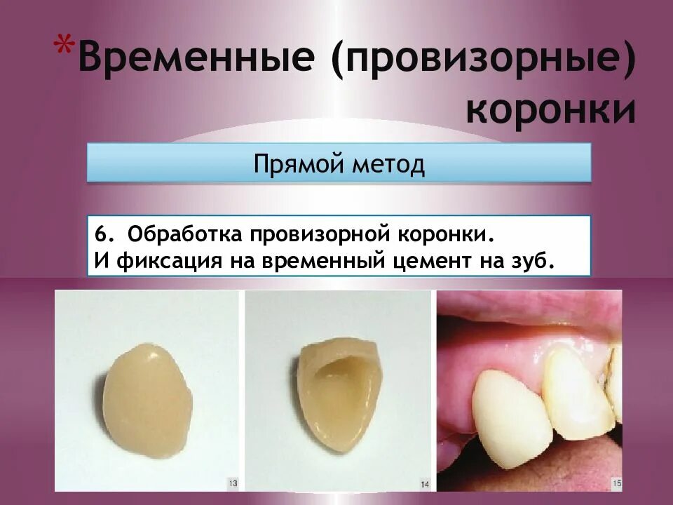 Временная коронка прямым методом. Временные Провизорные коронки. Временные коронки прямым методом.