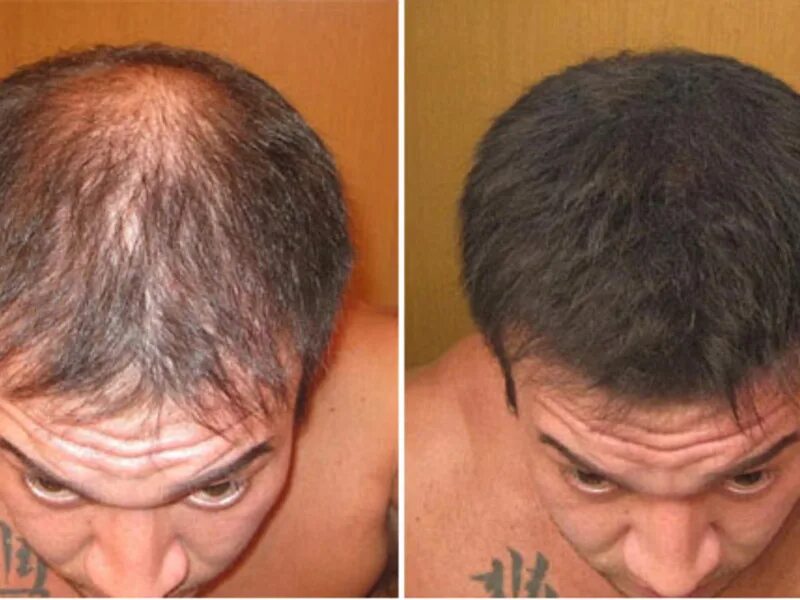 Голова вырастает. Растительность на голове. Экозависимая алопеция. Травяная голова. Миноксидил для волос на голове.