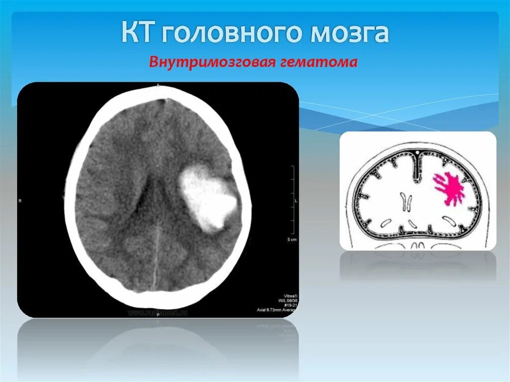 Эпидуральная гематома на кт. Объем эпидуральной гематомы. Внутримозговая гематома кт. Гематома головного мозга кт.