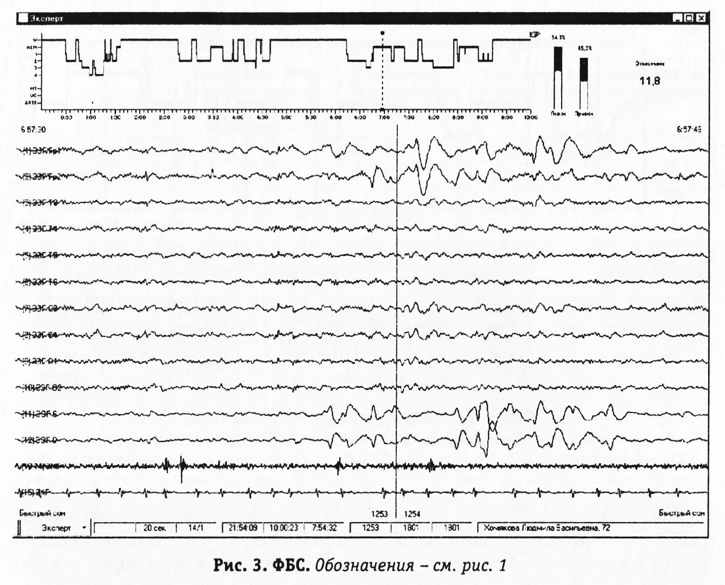 Пульс фазы сна. Rem стадия сна. Сонные веретена фаза сна. График глубины сна. Как понять в какой фазе сна человек.