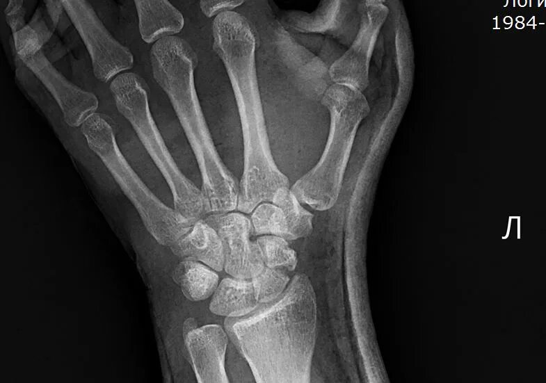 Перелом ладьевидной кости кисти руки. Ладьевидная кость перелом рентген. Перерос ладевидной кости рентген. Ладьевидная кость руки перелом рентгенограмма.