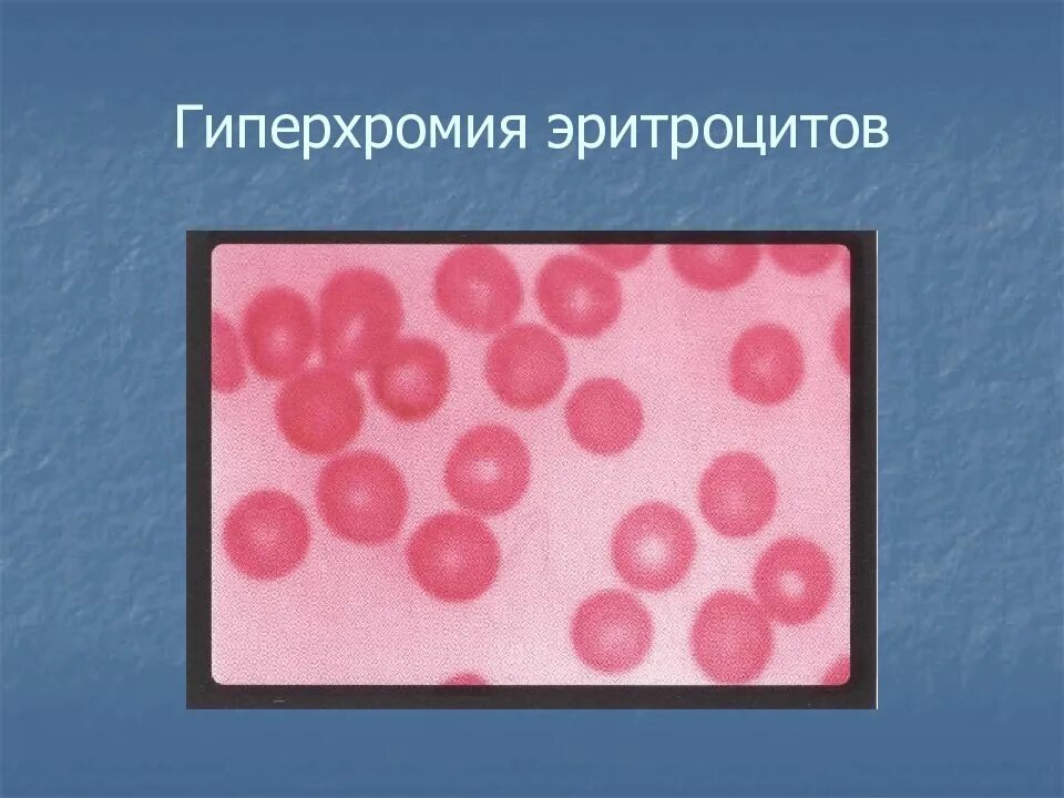 Эритроциты окрашиваемые. Гиперхромная анемия мазок крови. гиперхромная анемия эритроциты. гиперхромная макроцитарная анемия микроскоп. фолиеводефицитная анемия гиперхромная.
