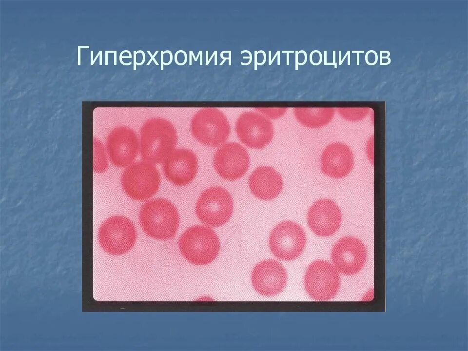 Пониженные макроциты. Гиперхромная анемия. Гипохромия и гиперхромия. Гиперхромная макроцитарная анемия микроскоп. Макроцитарная анемия (макроцитоз).