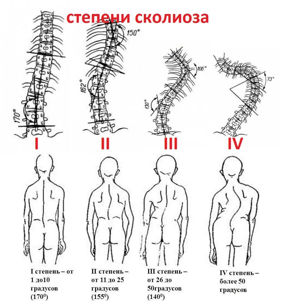 Сколиоз в какую сторону. Степени сколиоза позвоночника по градусам у детей. 1 степень сколиоза по чаклину рентген. позвоночник при сколиозе 2 степени. сколиоз позвоночника 4 степени рентген.