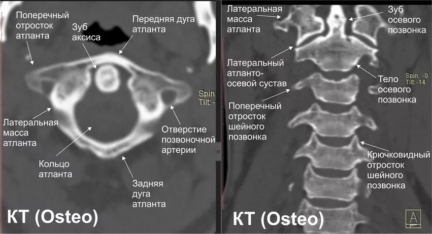 Ротационный подвывих Атланта с1 кт. 1 Шейный позвонок Атлант. Подвывих 1 и 2 шейного позвонка на кт. Кт анатомия шейного отдела позвоночника.