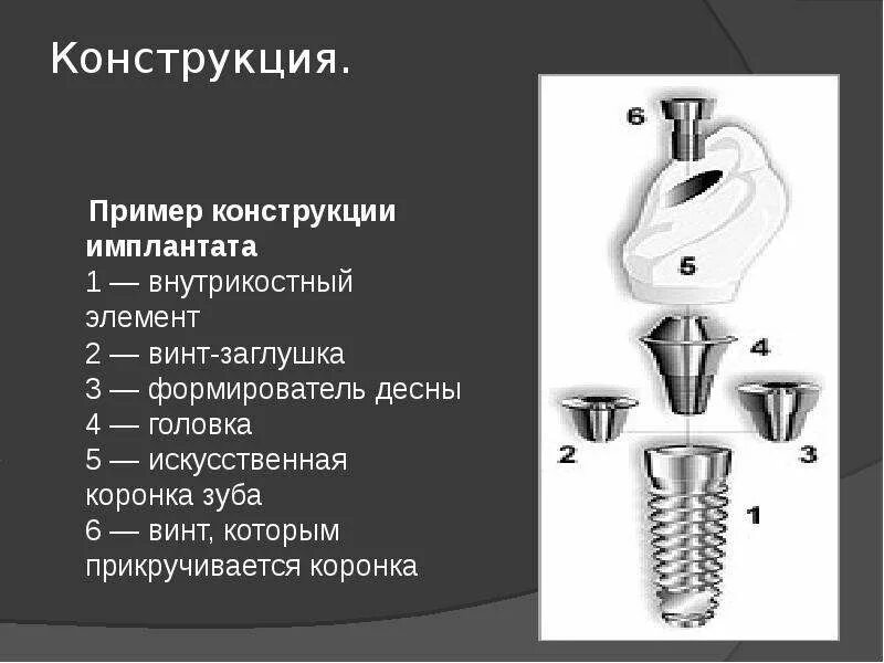 Заглушка на имплант зуба как выглядит Заглушка на имплант зуба как выглядит